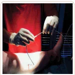 vascular-endovascular-therapy-venaseal-closure-in -pamc