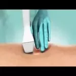venaseal