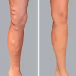 varicose vein surgery in pune