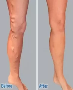 varicose vein surgery in pune