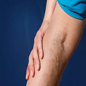 Varicose Veins treatment in pune