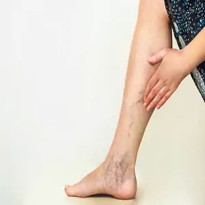 Varicose Veins surgery in pune